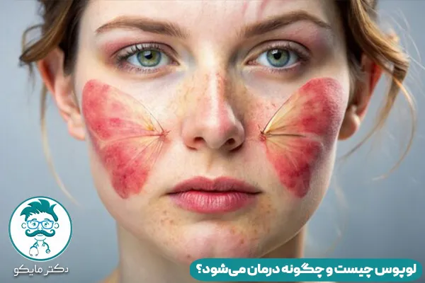 بیماری لوپوس چیست و چگونه درمان می‌شود؟