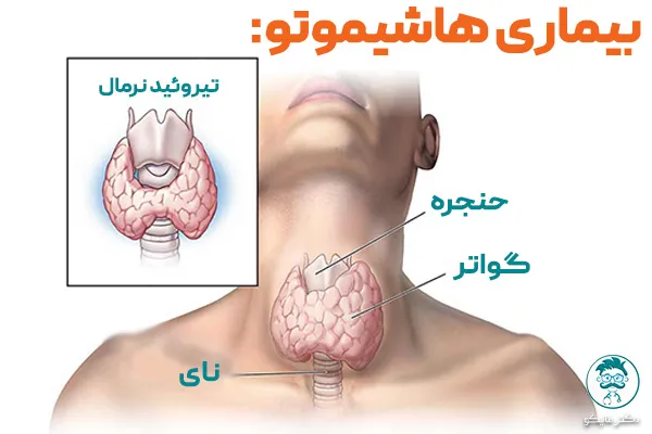 هاشیموتو و ام اس و سرطان