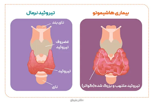 طول عمر بیماران هاشیموتو