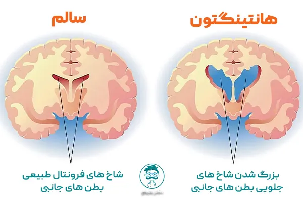 علت بیماری هانتینگتون چیست؟