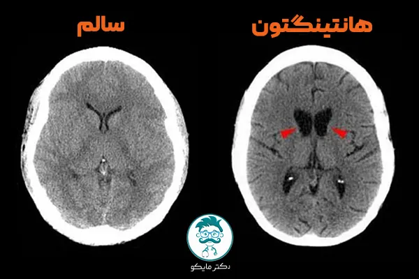 بیماری هانتینگتون در ایران