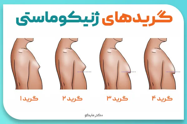 گریدهای ژنیکوماستی