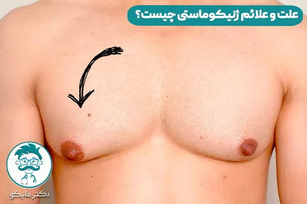 ژنیکوماستی چیست؟