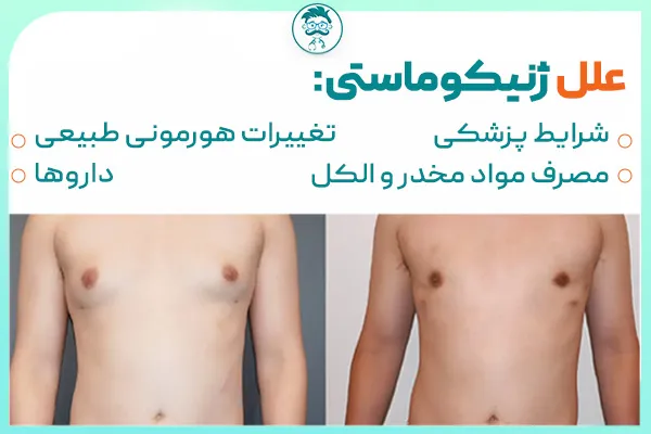 علل ژنیکوماستی: