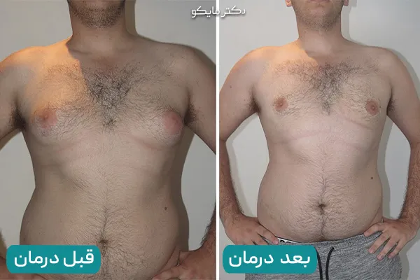 درمان خانگی ژنیکوماستی
