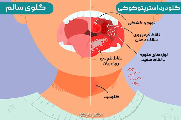 گلودرد چگونه است؟