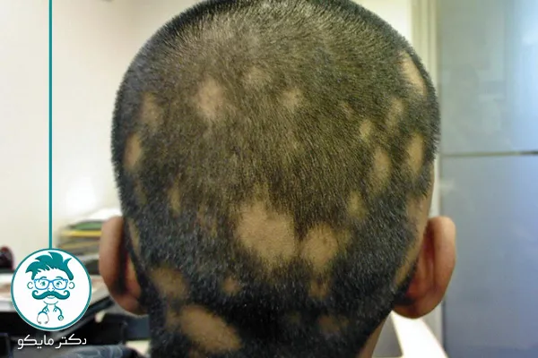 اسم آمپول ریزش موی سکه‌ ای