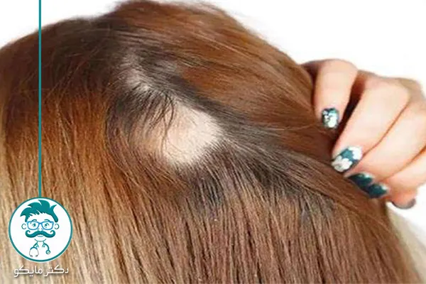 درمان ریزش موی سکه‌ ای در زنان