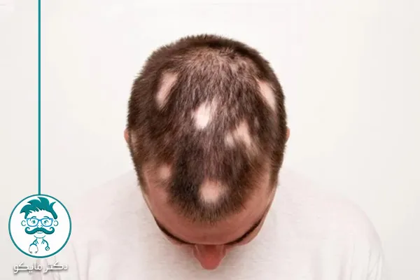 تشخیص ریزش موی سکه‌ ای