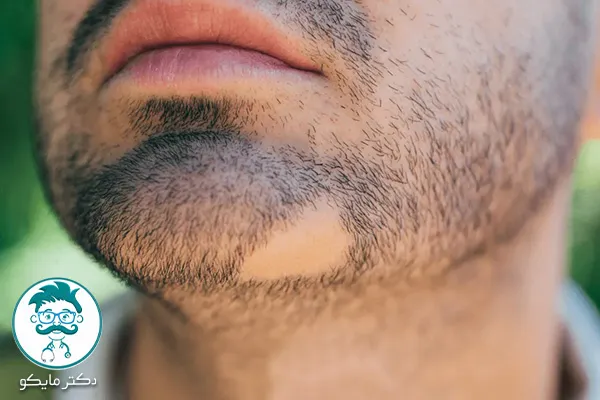 ریزش مو سکه‌ ای ریش مردان