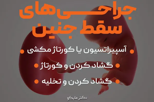 سقط جنین جراحی