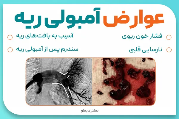 عوارض آمبولی ریه