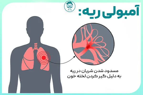 آمبولی ریه چیست؟