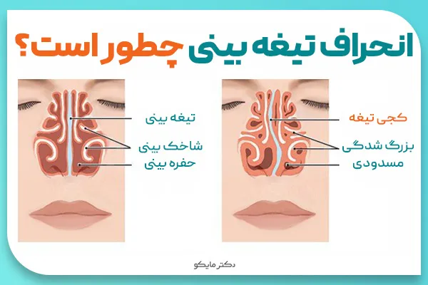 انحراف بینی چطور است؟