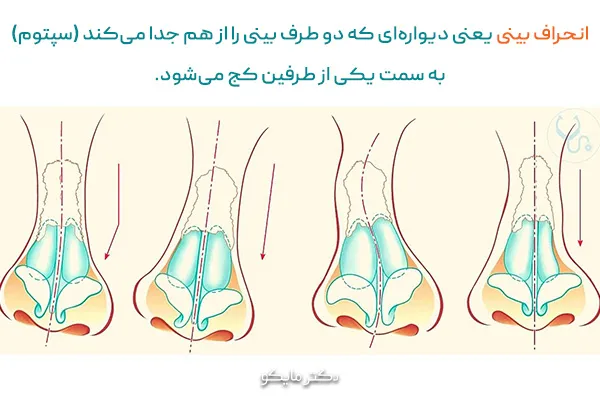 علت انحراف بینی چیست؟