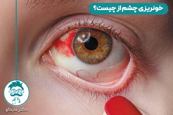 خونریزی چشم از چیست؟