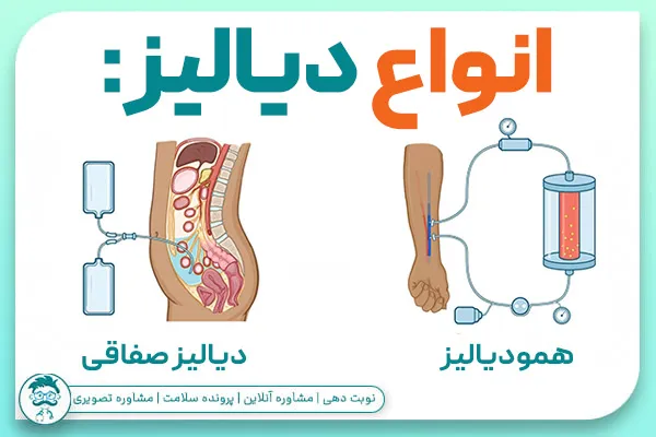 انواع دیالیز