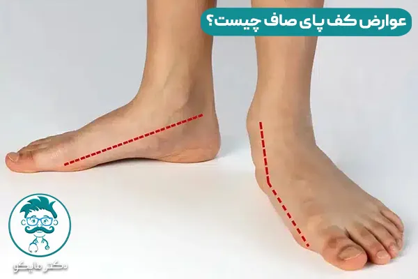 کف پای صاف چیست؟