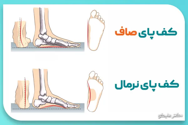 شکل کف پای صاف