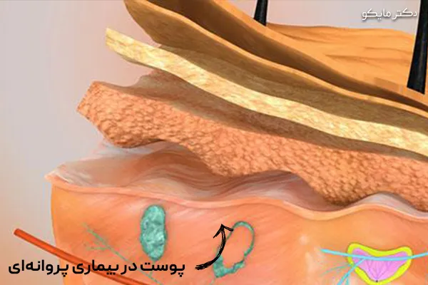 پوست در بیماری پروانه ای چگونه است؟