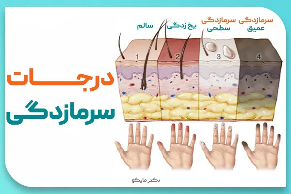 درجات سرمازدگی