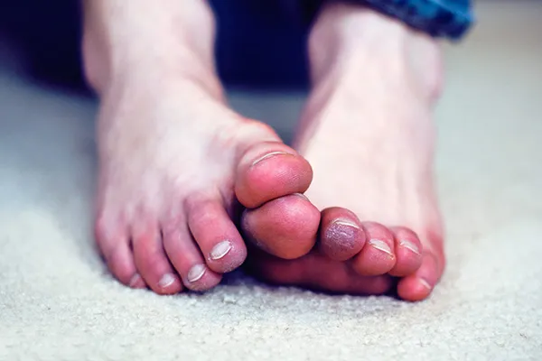 علائم سرمازدگی چیست؟ عوارض سرمازدگی انگشتان پا، دست، پوست صورت و چشم