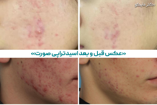 عکس اسیدتراپی صورت