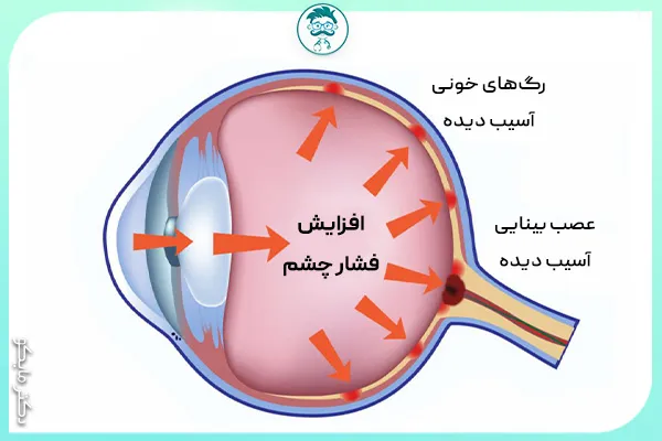 فشار چشم بالا چیست؟