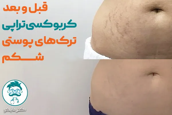 عکس قبل و بعد کربوکسی ‌تراپی ترک شکم