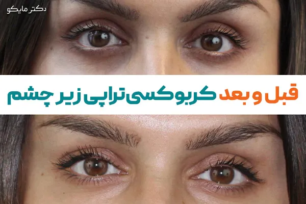 عکس قبل و بعد کربوکسی ‌تراپی زیر چشم