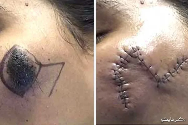 خال برداری با جراحی
