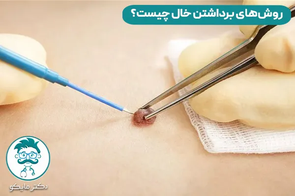 برداشتن خال