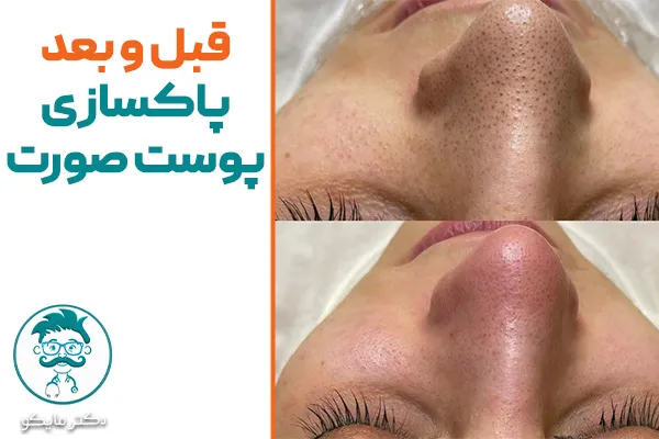 عکس قبل و بعد پاکسازی صورت