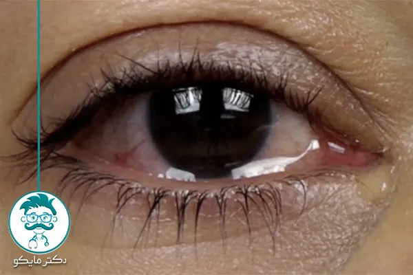 آبریزش چشم چیست؟