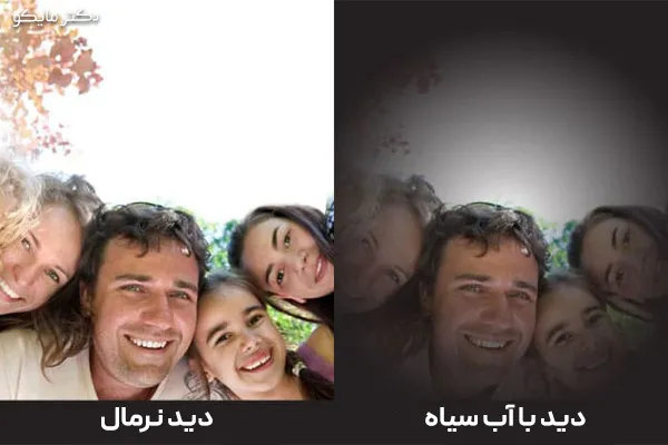 عکس گلوکوم چشم