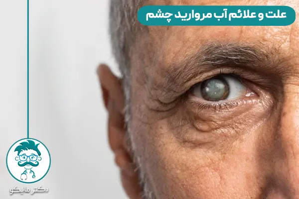 آب مروارید چشم