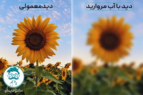 عکس آب مروارید چشم