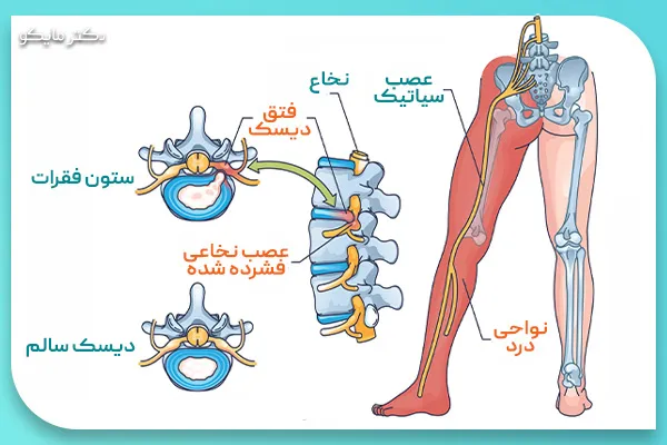 درد سیاتیک چیست؟