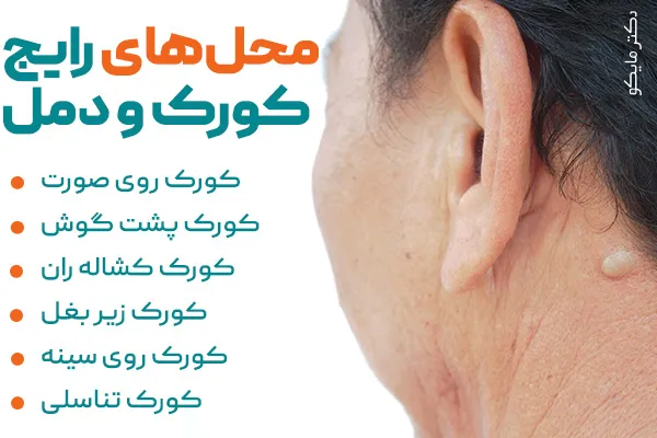 مکان ایجاد دمل یا کورک پوستی