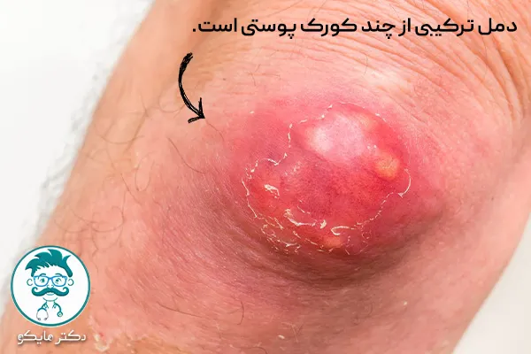 دمل چیست؟