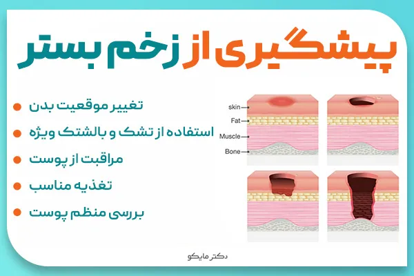 پیشگیری از زخم بستر