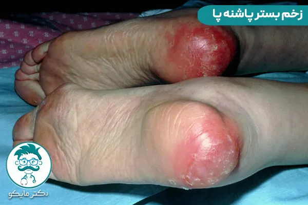 زخم بستر پاشنه پا