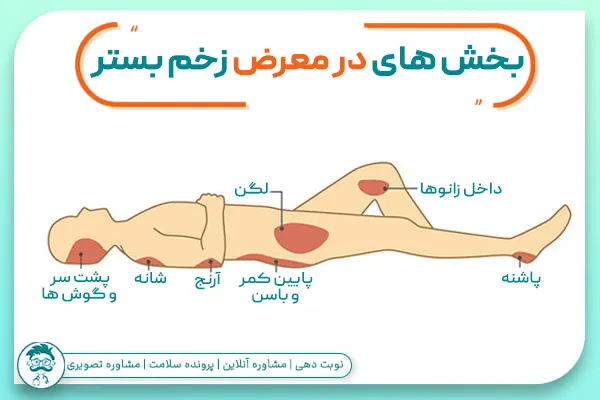 درمان زخم بستر جاهای مختلف بدن