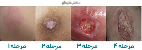 عکس انواع زخم بستر