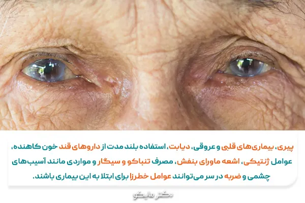 علت آب مروارید چشم چیست؟