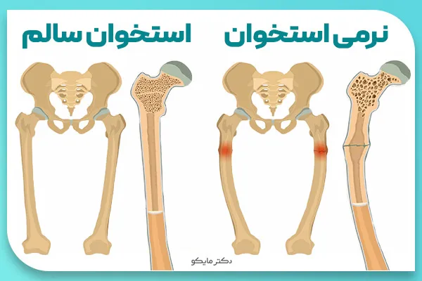 راشیتیسم چیست؟