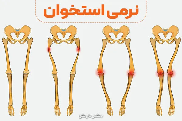 آیا نرمی استخوان درمان قطعی دارد؟
