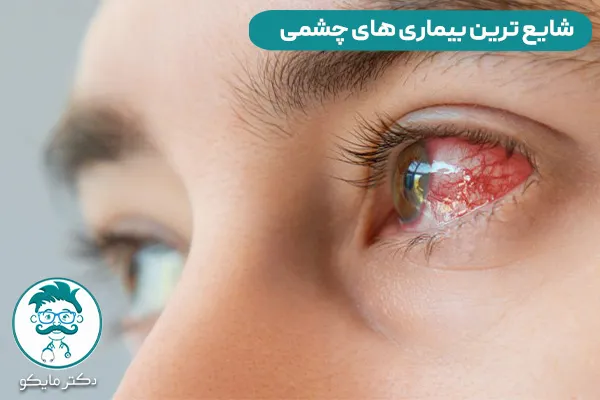 شایع ترین بیماری های چشمی چیست؟