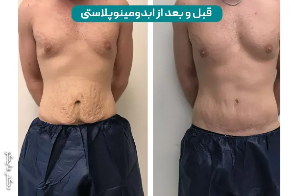 عکس قبل و بعد ابدومینوپلاستی