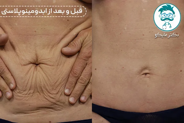 ابدومینوپلاستی همزمان با سزارین